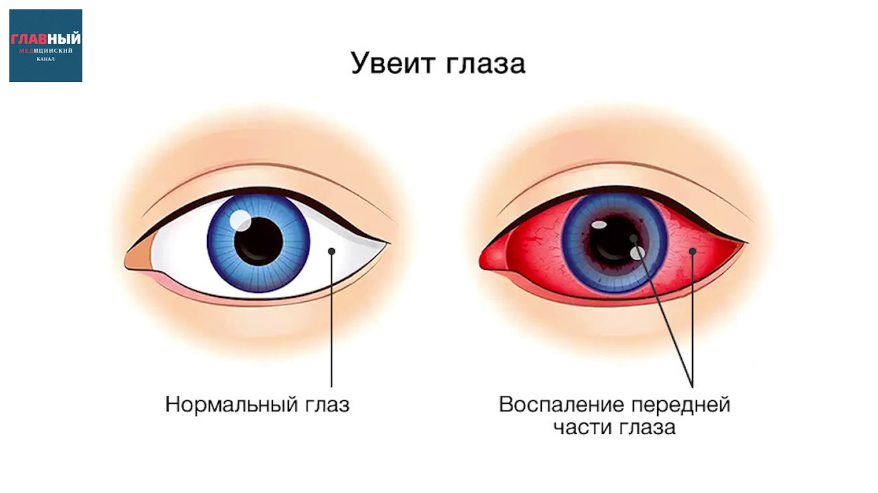 УВЕИТ ГЛАЗА. Острый Иридоциклит, ирит и хориоидит. Симптомы и лечение увеита