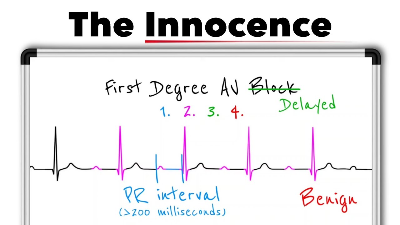 Атриовентрикулярная блокада первой степени: объяснение | Интерпретация ЭКГ, интервал PR и клиниче...