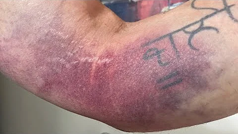 Day 8: Tricep Tendon Tear/ Recovery