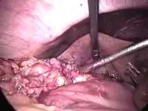 Chr. Cholecystitis Case Which Was Converted Due To Severe Adhesions-1