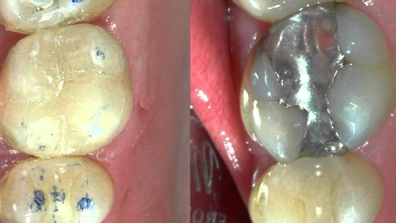 Replacing Silver Fillings with a Los Angeles Cosmetic Dentist YouTube