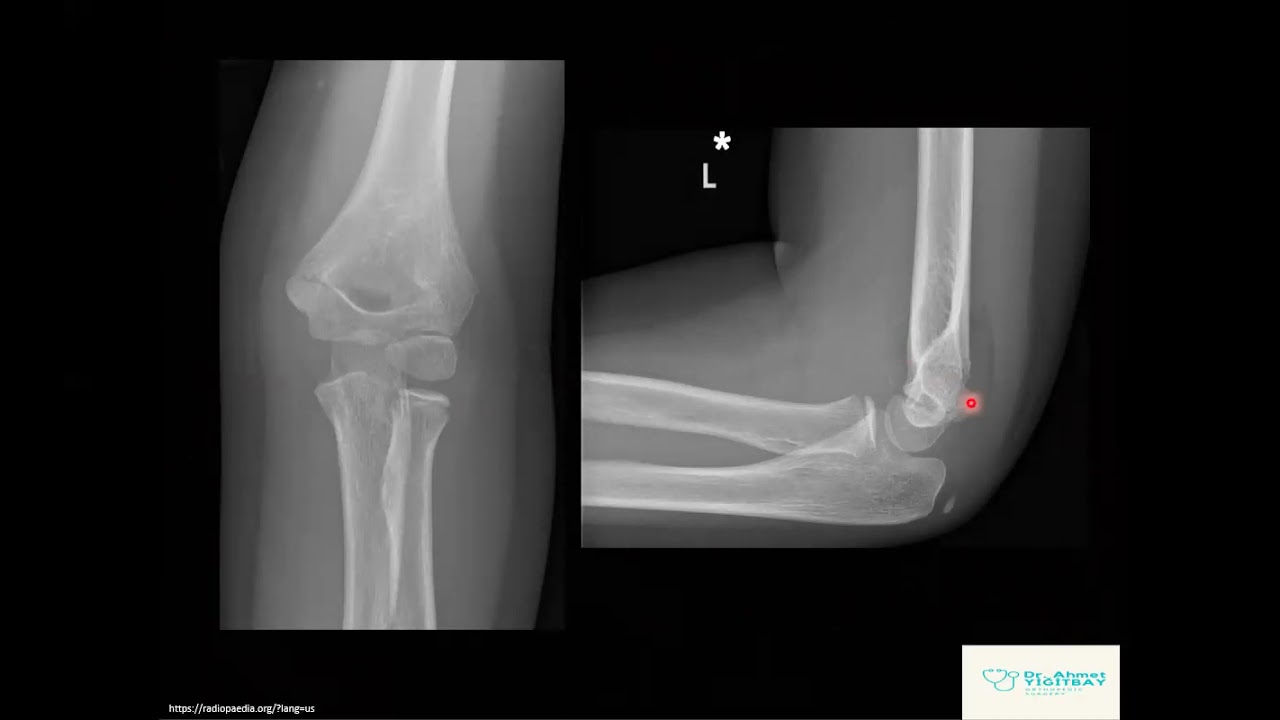 Pediatrik Dirsek Röntgeni Yorumlama Teknikleri