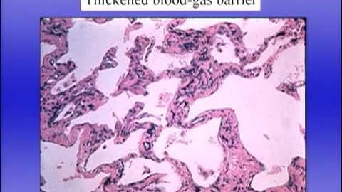 Pulmonary Function Test