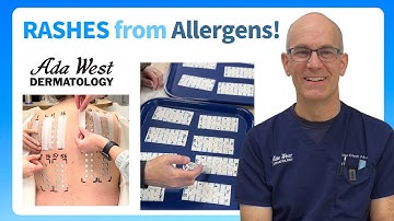 Patch testing for skin allergy in Boise with Ada West Dermatology