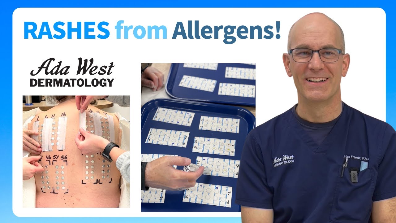 Patch testing for skin allergy in Boise with Ada West Dermatology - YouTube