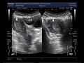 Ultrasound Video showing Endometrial hyperplasia in 33 years old female.