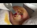 Super infected nail digging
