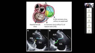 Tricuspid Valve