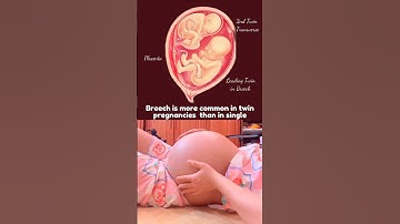 Twin Pregnancy in Breech Presentation 🥰 #twin #twinbaby #twinpregnancy