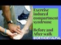 Exercise Induced Compartment Syndrome Signs and Symptoms