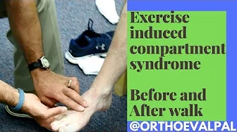 Exercise Induced Compartment Syndrome Signs and Symptoms