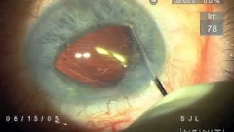 Management of a Dislocated IOL