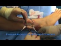 Jessica cecs and superficial fibular nerve entrapment