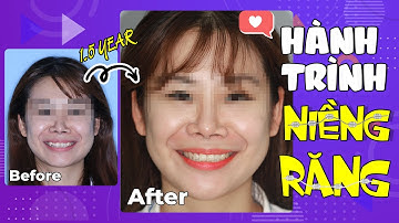 Hành Trình Niềng Răng: Tạm Biệt Chen Chúc - Cắn Hở Với Khay Niềng Răng Trong Suốt Vinalign