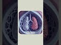 Pulmonary Alveolar Proteinosis