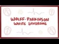 Wolff-Parkinson-White syndrome (WPW) - causes, symptoms & pathology