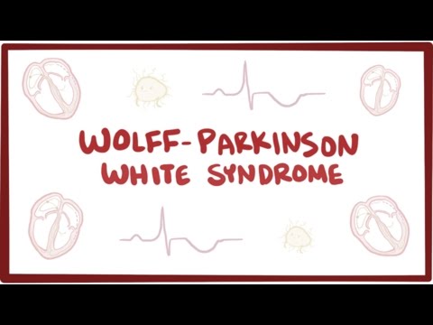 Video: Wolff-Parkinson-White-sindromas: Simptomai, Priežastys Ir Kita