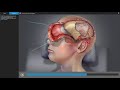 Traumatic brain injury  brain surgery animation