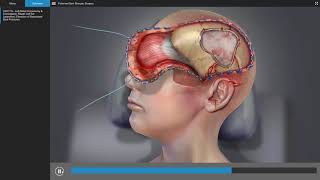 Traumatic Brain Injury - Brain Surgery Animation screenshot 3