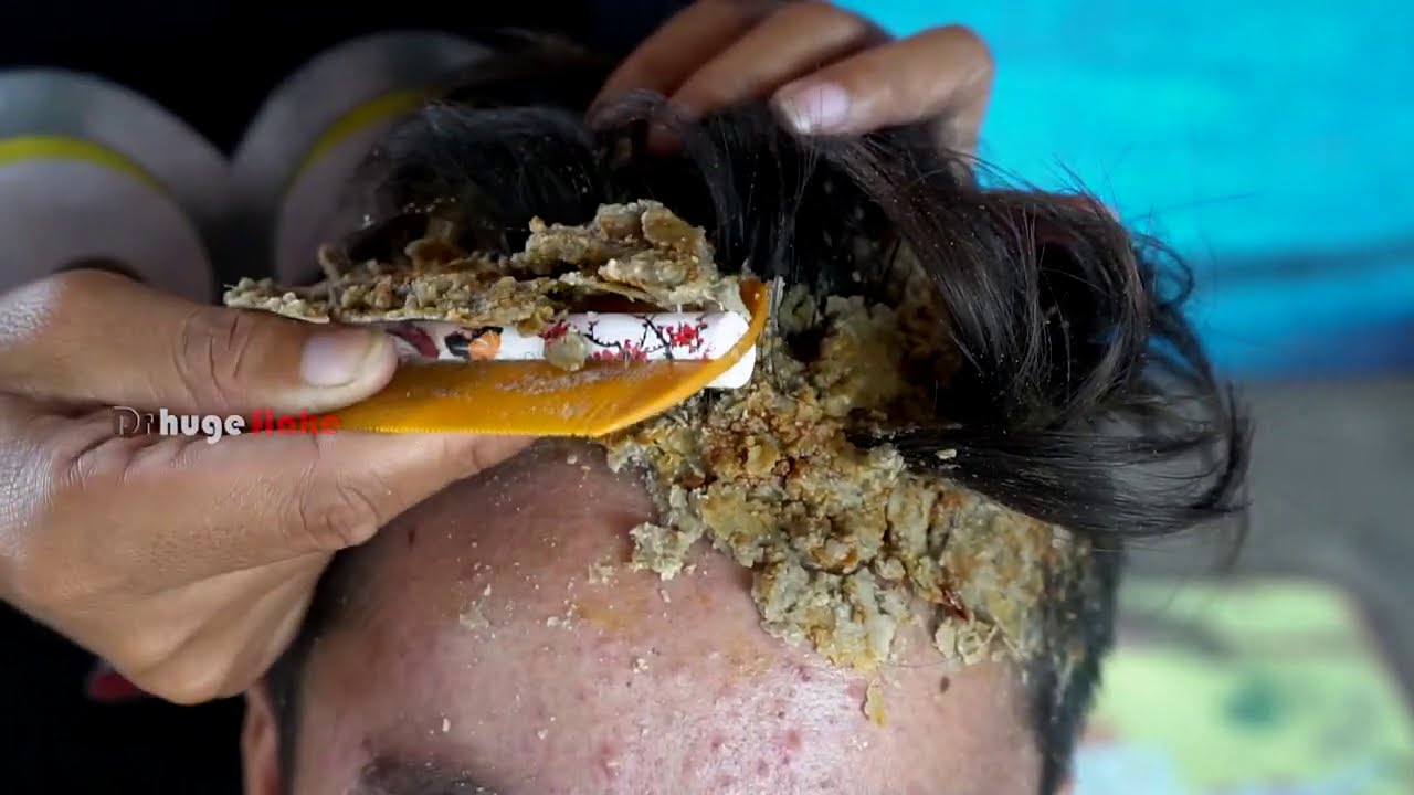 scalp psoriasis removal asmr