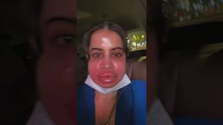 Omg Urfi Javed Lip Fillers