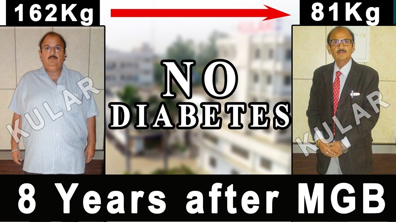 Happy Patient| Lost 81 Kgs| 8 years after Mini Gastric Bypass (Bariatric Surgery)…