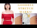 SAY GOODBYE TO STRETCHMARKS | EFFECTIVE WAYS