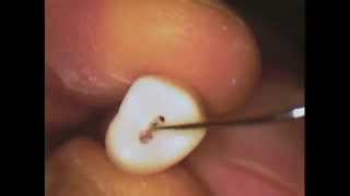 Session 7 - Endodontics - Root Canal Therapy - Cleanse and Shape - Post Room