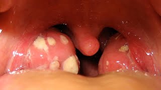 التهاب اللوزتين | مضاعفات التهاب اللوزتين الخطيرة complications of tonsillitis