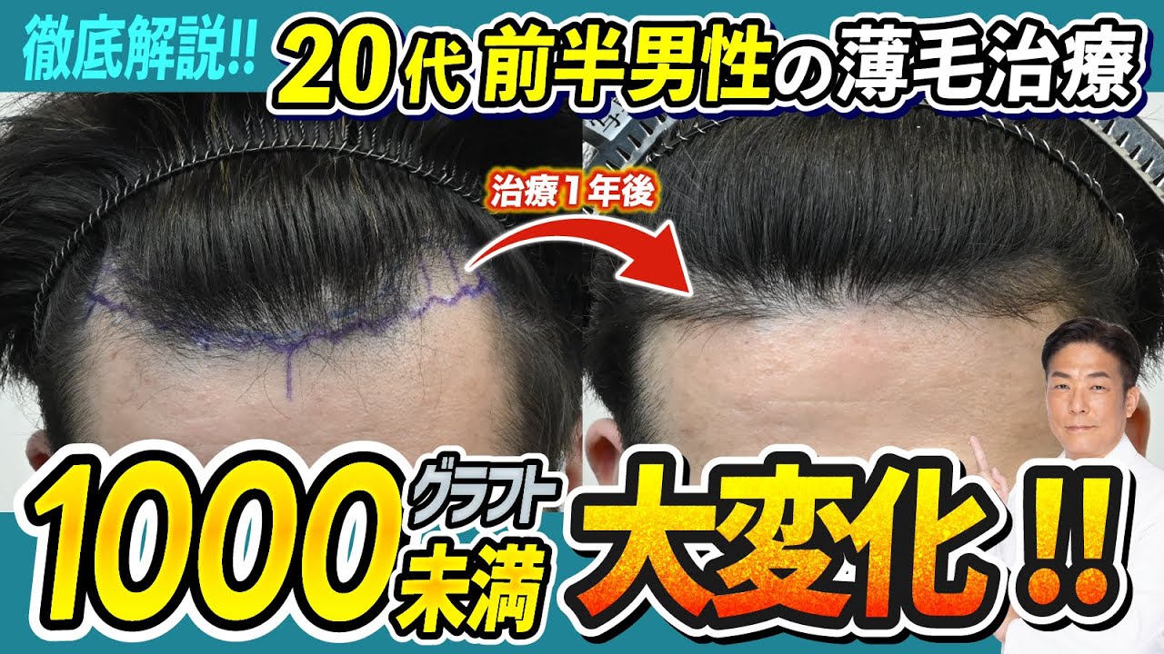 徹底解説】少ないグラフト数で元々毛が無かったM字を改善！スリットが