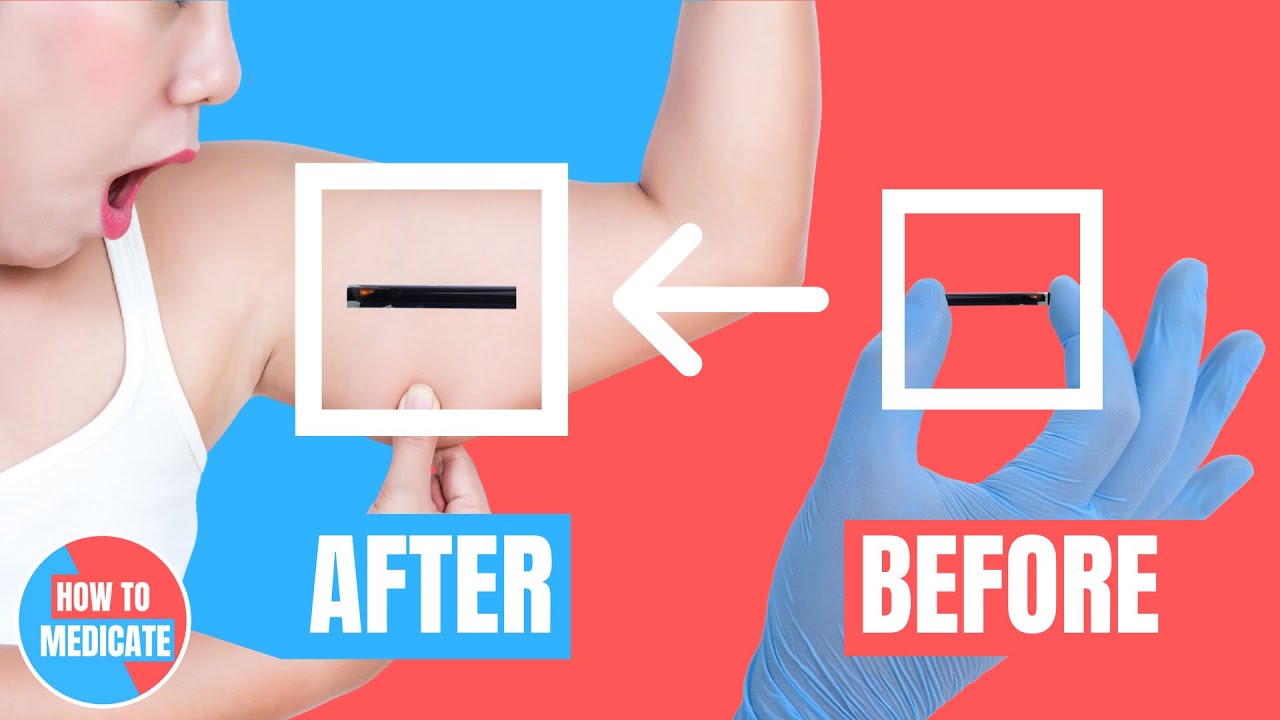 How to use birth control implant? (Implanon, Nexplanon, Etonogestrel