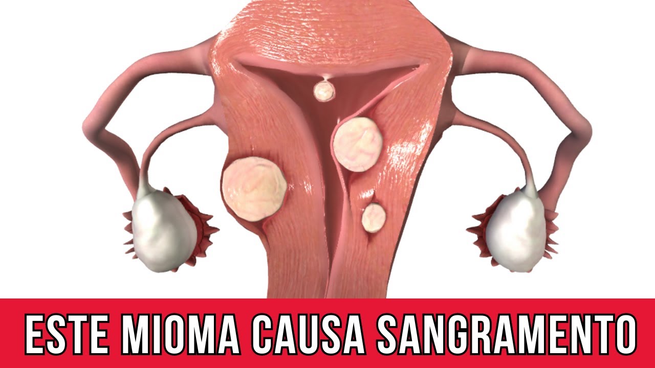 Sangramento em excesso na menstruação pode ser mioma; entenda