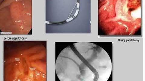 ERCP and T Tube cholangiography