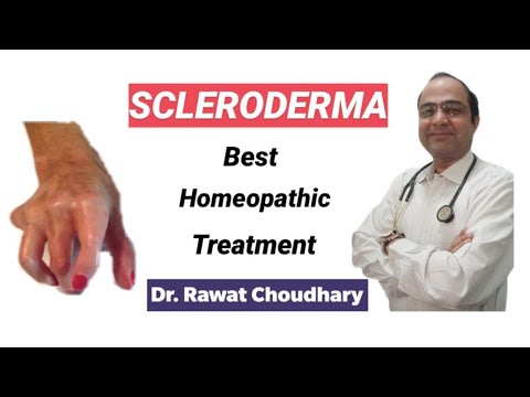 Scleroderma /crest syndrome/systemic sclerosis