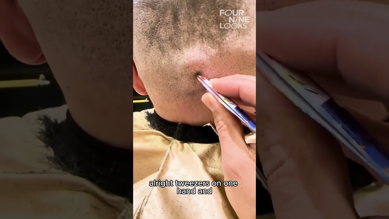Clutter Of Ingrown Hairs TT Kuaforrekremkacar