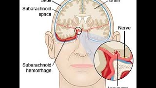 Subarachnoid Hemorrhage