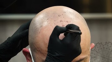 Alternatives to Hair transplant for Men. Scalp Micropigmentation Video Tutorial