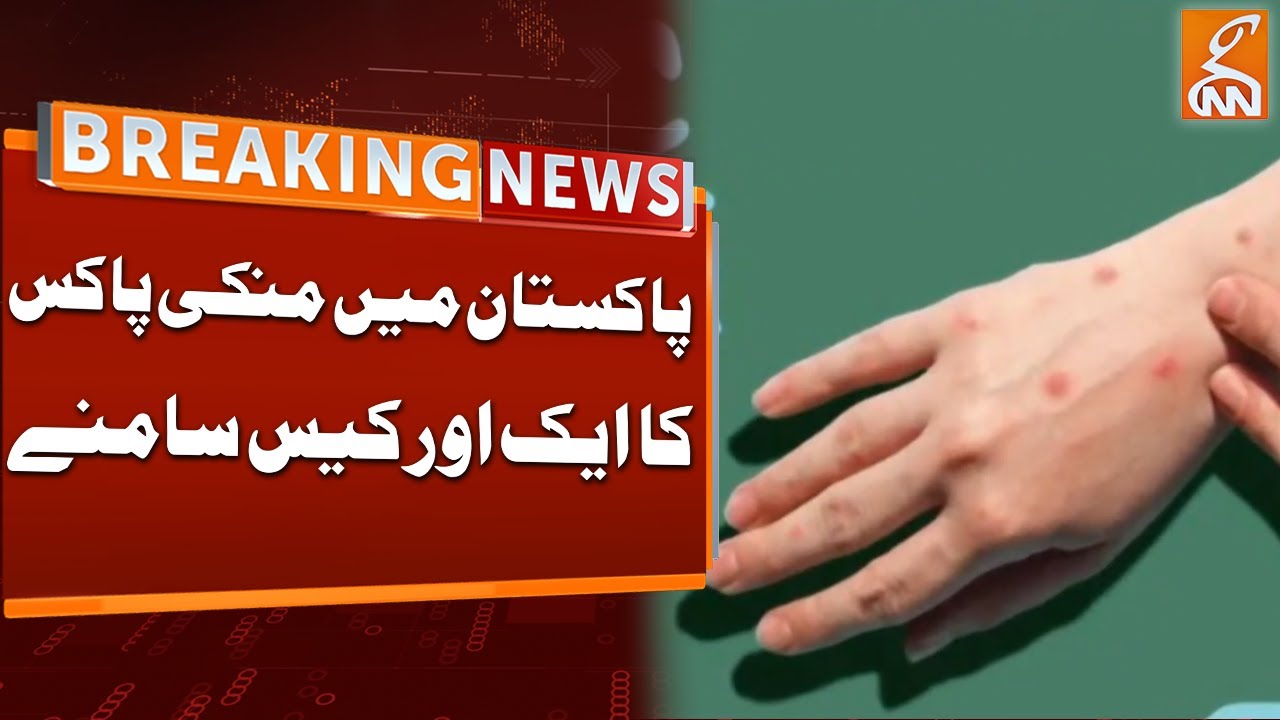 New Case Of Monkey Pox in Pakistan | New Pandemic | Breaking News | GNN ...