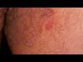 Jock Itch Home Treatment|5 ways to Cure Jock Itch Fast,Jock Itch Home Remedy