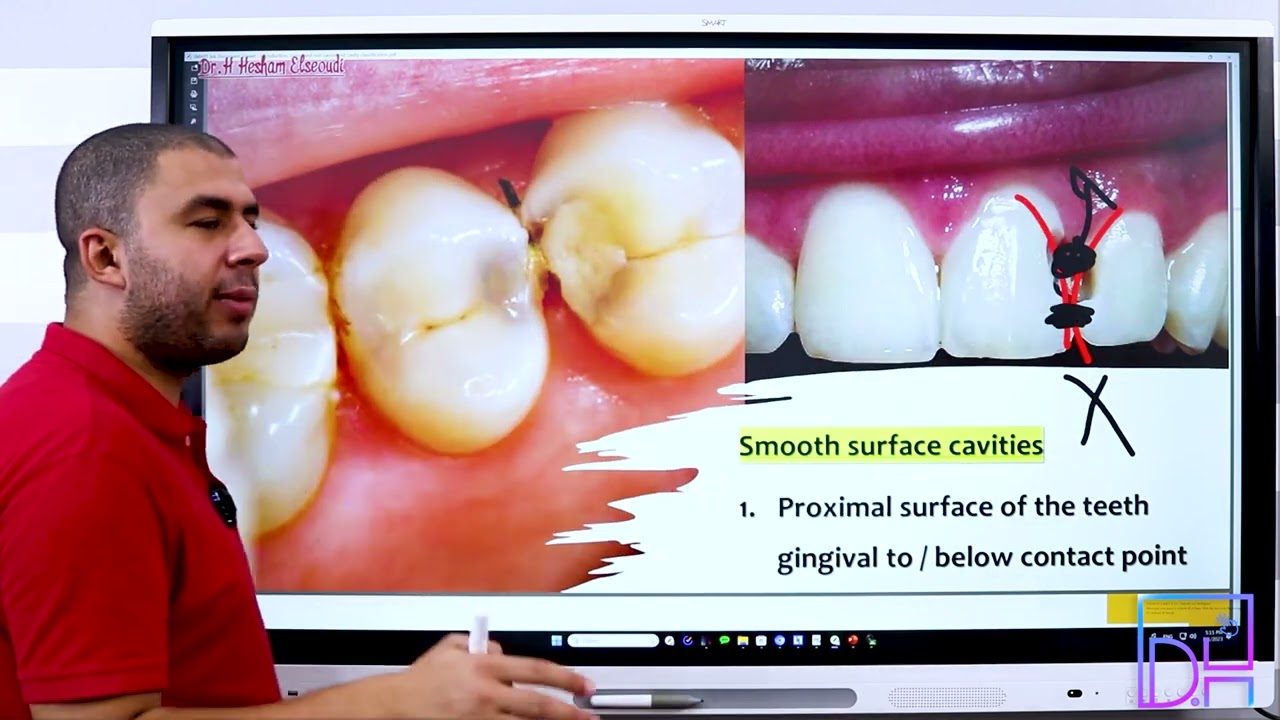7- Classification of Dental Caries P2 ما هي أنواع التسوس المختلفة التى تصيب الأسنان الجزء الثانى