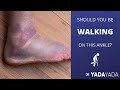 SPRAINED ANKLE!  Do you need an X-ray? When can you walk on it?