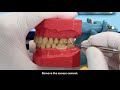 RelyX U 200 cementation on zirconia crown