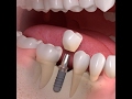 كيف تتم زراعة الاسنان ؟ - Dental Implant
