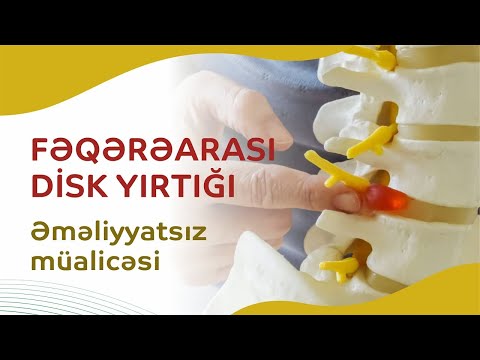 Fəqərəarası disk yırtığının