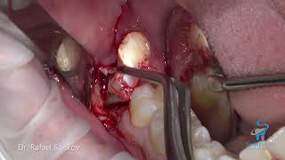 Lower Wisdom Tooth Extraction With Dentin Graft