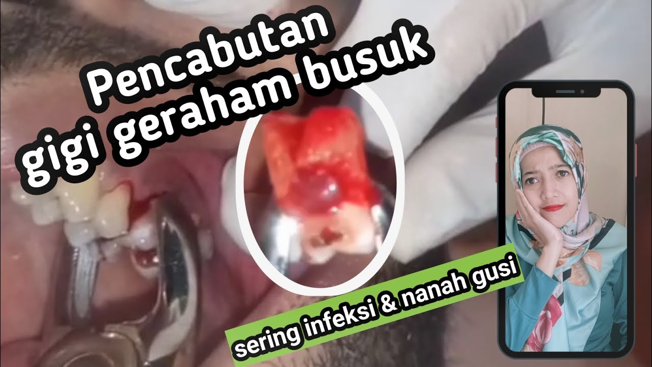 Pencabutan gigi geraham atas sering bengkak dan keluar nanah di gusi