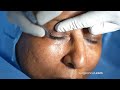 Lower Eyelid Surgery for Tired Eyes - Blepharoplasty by Dr Sunil Richardson