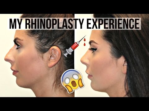 My Rhinoplasty Experience with Eric M. Joseph, M.D.