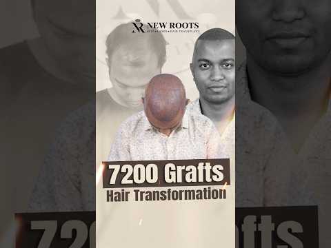 Hair Transplant in Bangladesh (7200 Grafts) | Case Study | Bangla #hair #bangladesh #shorts