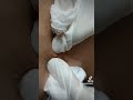 pustula purulenta,la rădăcina firului de par..extracții și asepticizarea!